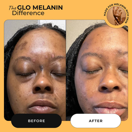 Dark Spot Corrector Serum - Glo Melanin