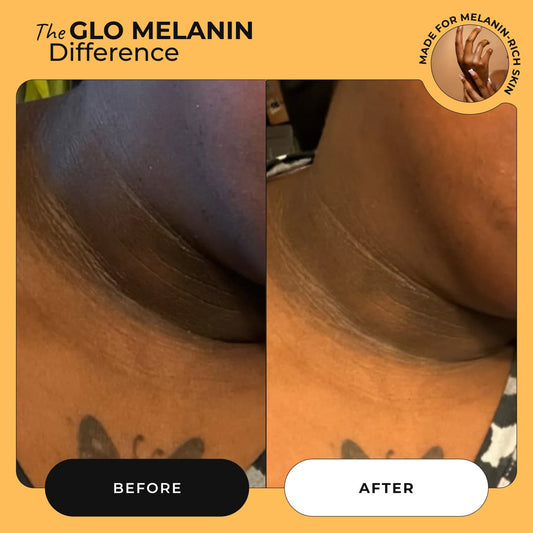 Magic Eraser Dark Spot Cream - Glo Melanin