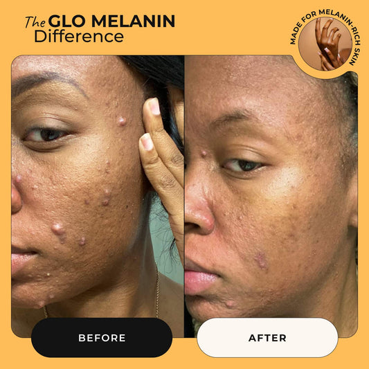 Turmeric and Kojic Foaming Face Wash - Glo Melanin