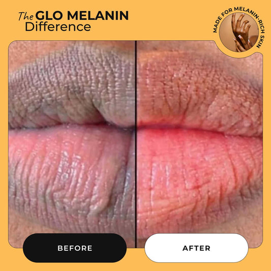 Turmeric and Lemon Lip Balm (for Dark Lips) - Glo Melanin