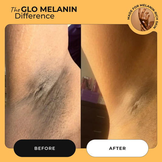 Dark Spot Roller 50 ml (inner thighs and underarms) - Glo Melanin