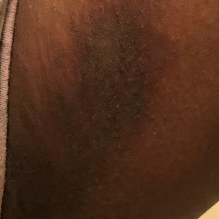 Dark spots on your inner thighs that show up every summer
