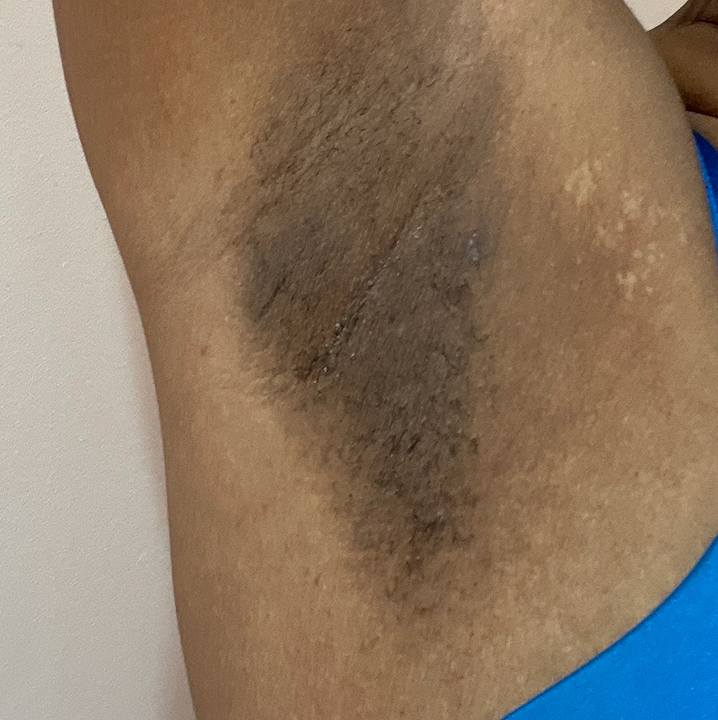 Uneven underarms you have been covering up for years