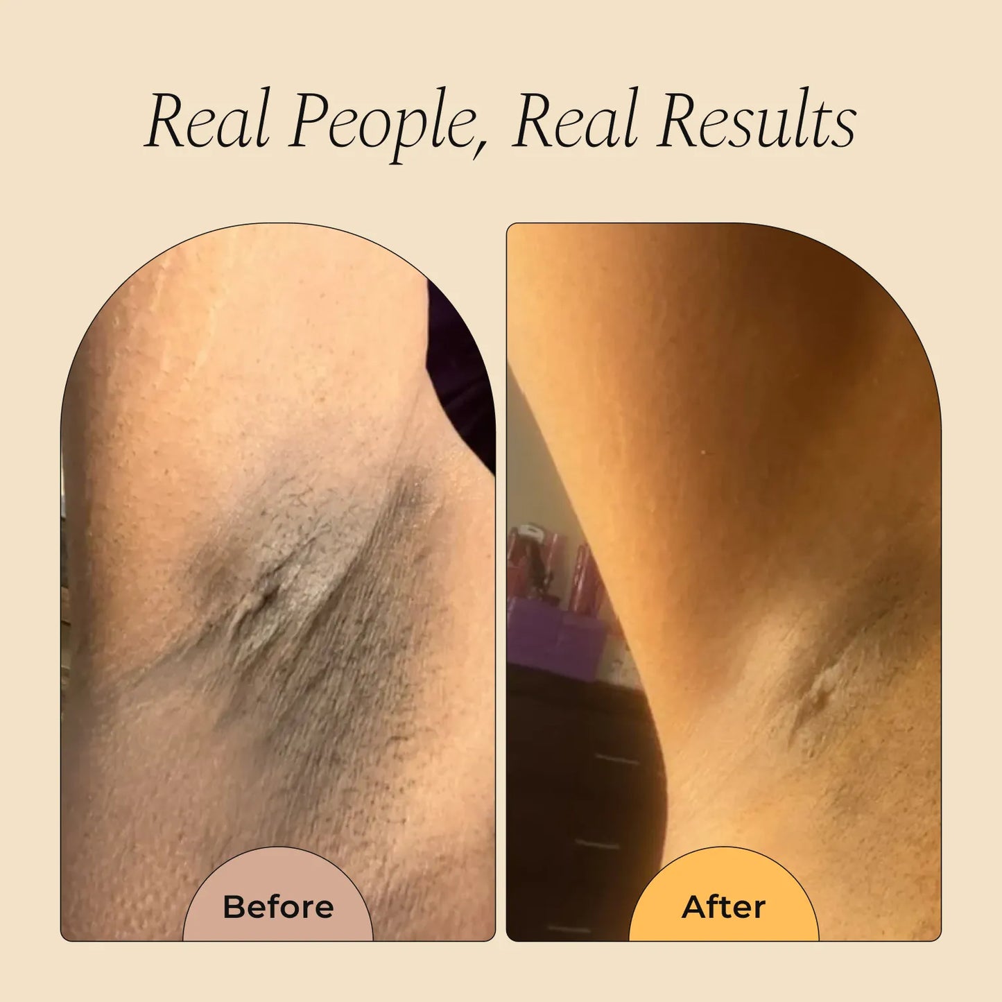 Roller Remover (ingrowns and dark spots)